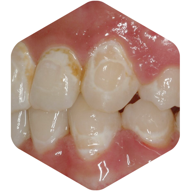 Teeth with moderate discoloration